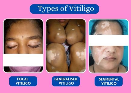 types of vitiligo